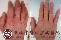 合肥淮大皮肤病医院皮肤科